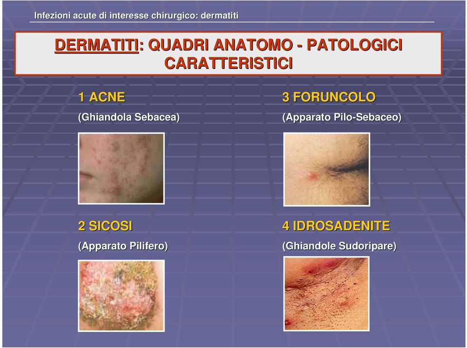 ACNE (Ghiandola Sebacea) 3 FORUNCOLO (Apparato