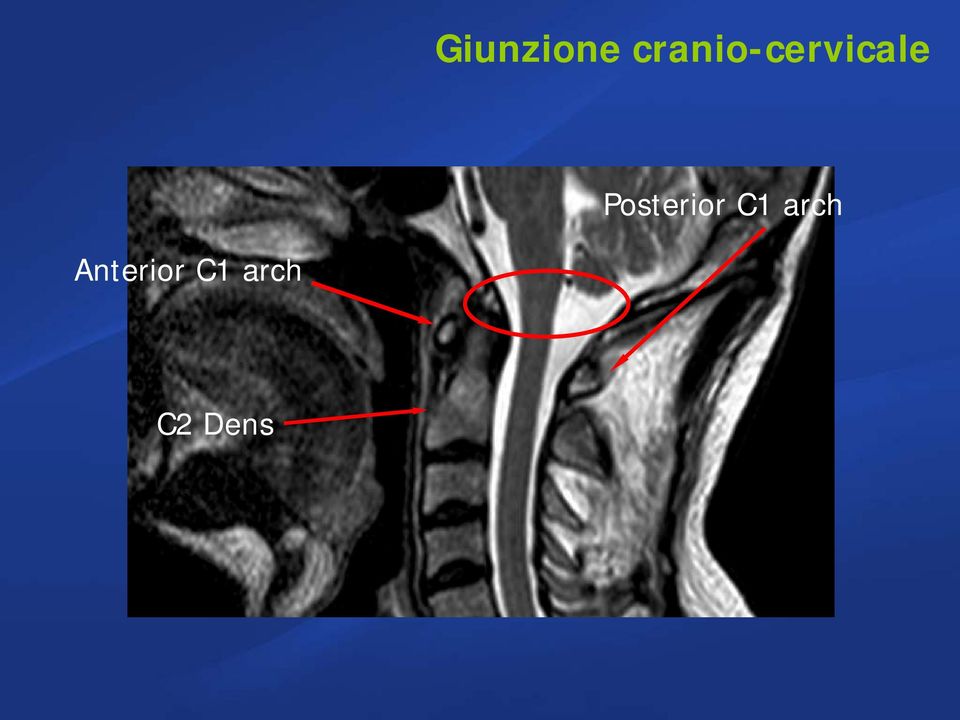 Posterior C1 arch