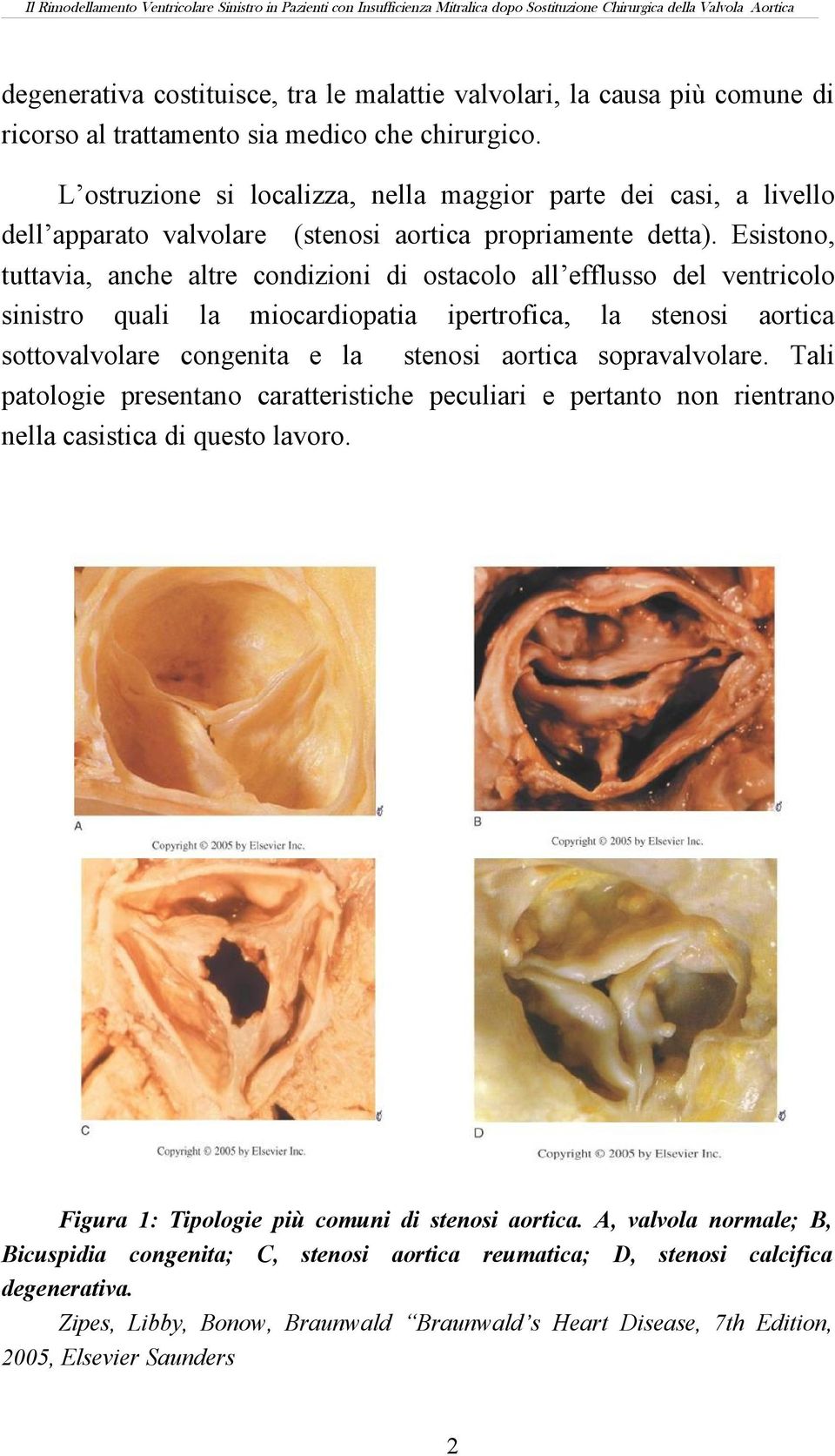 Esistono, tuttavia, anche altre condizioni di ostacolo all efflusso del ventricolo sinistro quali la miocardiopatia ipertrofica, la stenosi aortica sottovalvolare congenita e la stenosi aortica