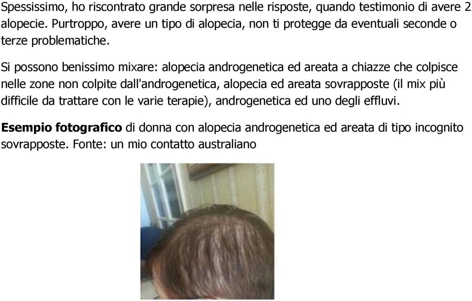 Si possono benissimo mixare: alopecia androgenetica ed areata a chiazze che colpisce nelle zone non colpite dall'androgenetica, alopecia ed