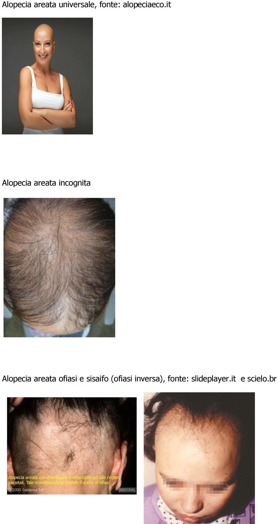 it Alopecia areata incognita Alopecia