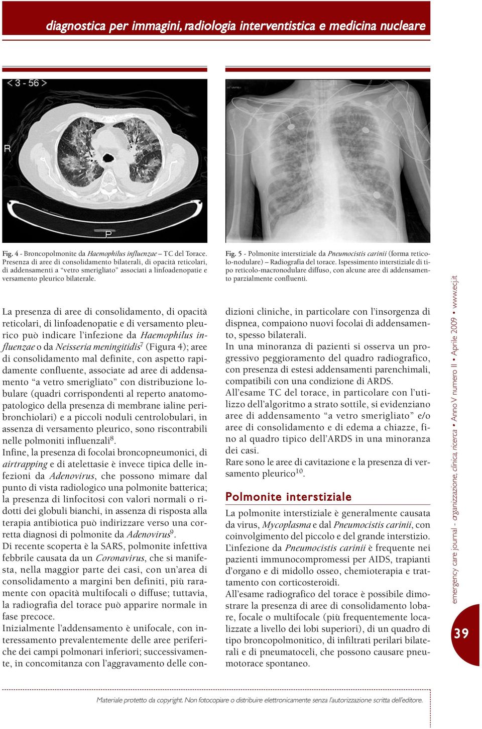 5 - Polmonite interstiziale da Pneumocistis carinii (forma reticolo-nodulare) Radiografia del torace.