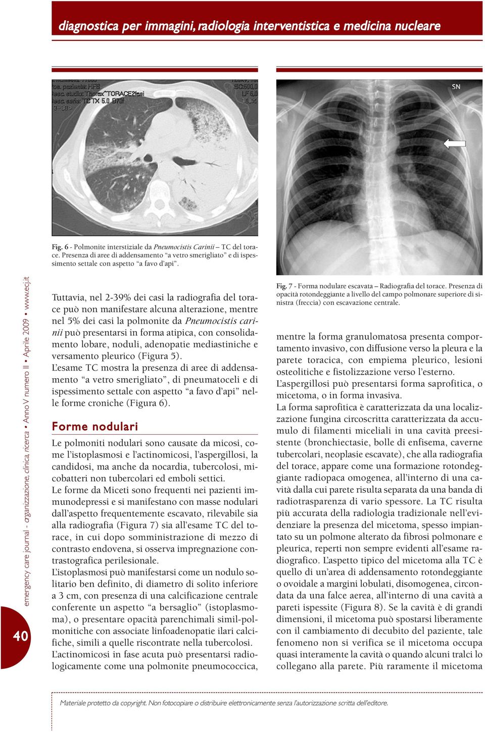 consolidamento lobare, noduli, adenopatie mediastiniche e versamento pleurico (Figura 5).