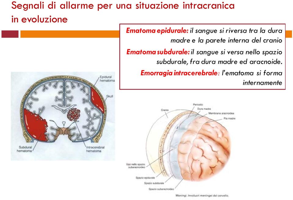 cranio Ematoma subdurale: il sangue si versa nello spazio subdurale, fra