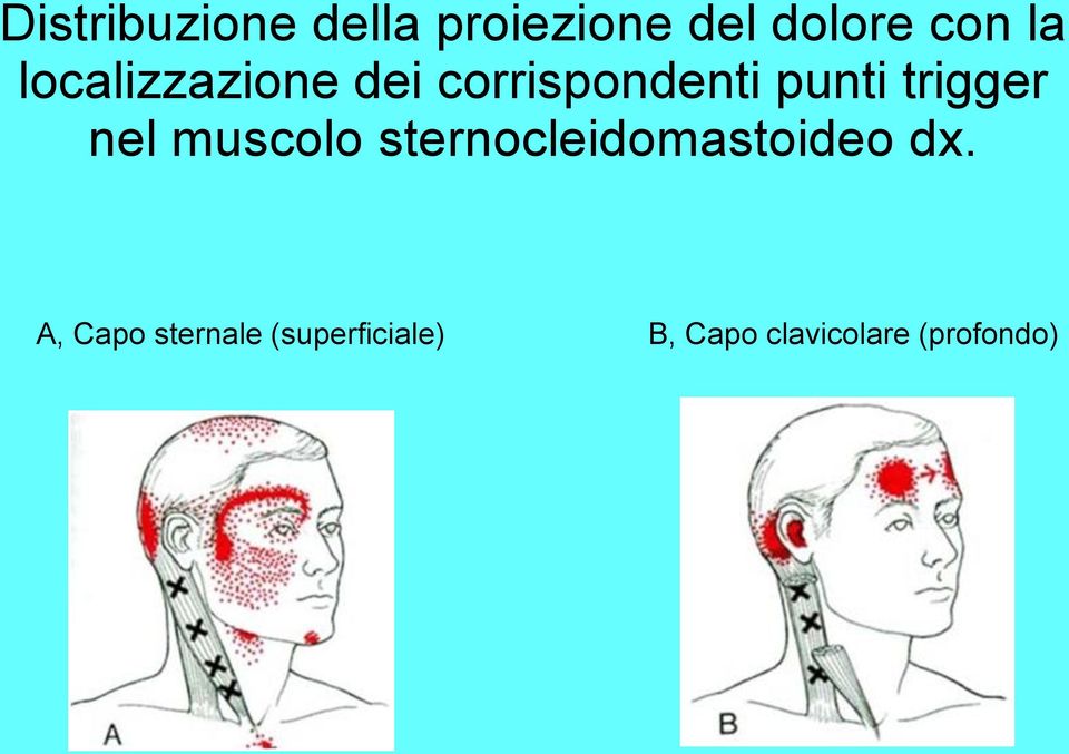 nel muscolo sternocleidomastoideo dx.