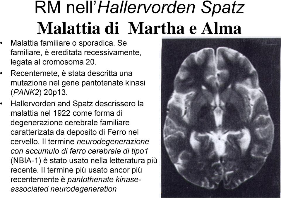 Hallervorden and Spatz descrissero la malattia nel 1922 come forma di degenerazione cerebrale familiare caratterizata da deposito di Ferro nel cervello.
