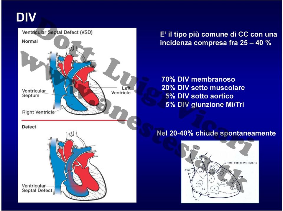 incidenza compresa fra 25 40 % 70% DIV membranoso