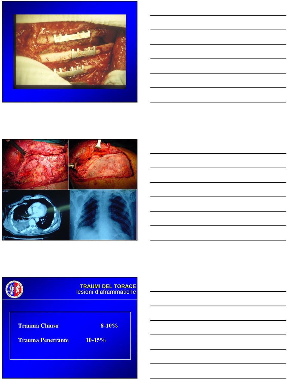 diaframmatiche Trauma