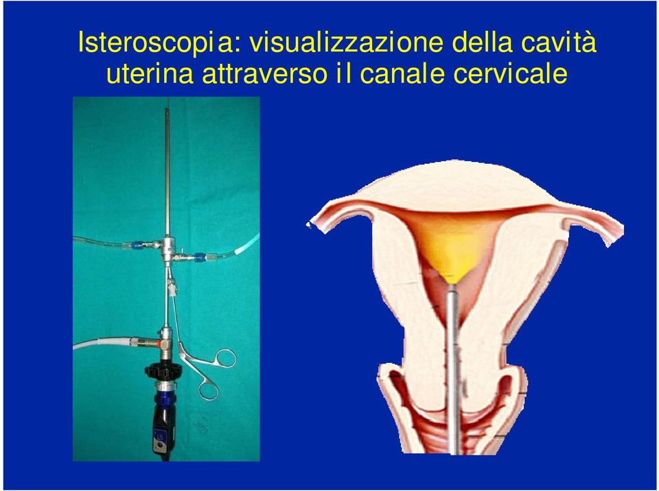 della cavità uterina