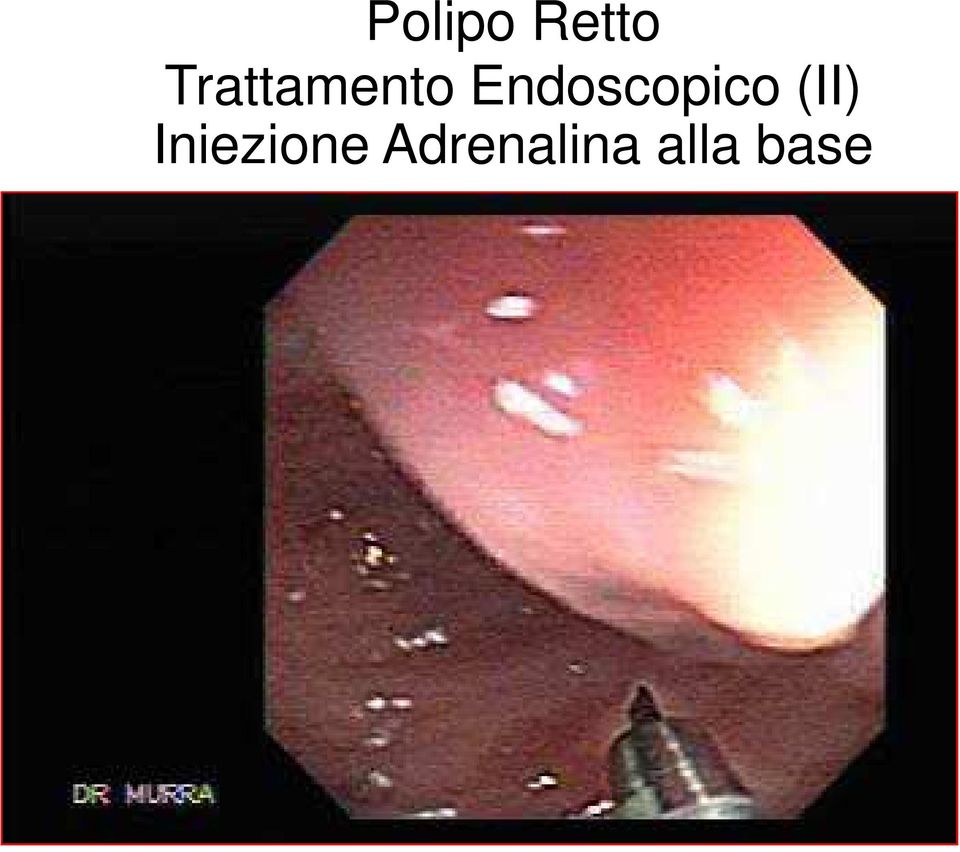 Endoscopico (II)