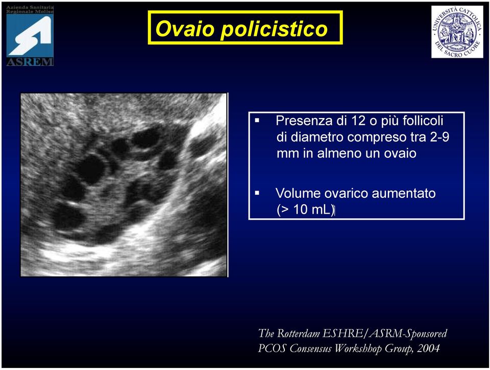 Volume ovarico aumentato ( ml (> 10 The Rotterdam