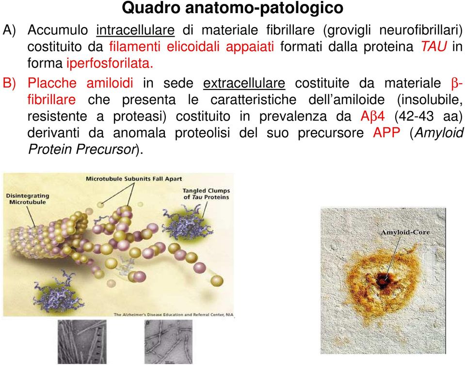 B) Placche amiloidi in sede extracellulare costituite da materiale β- fibrillare che presenta le caratteristiche dell