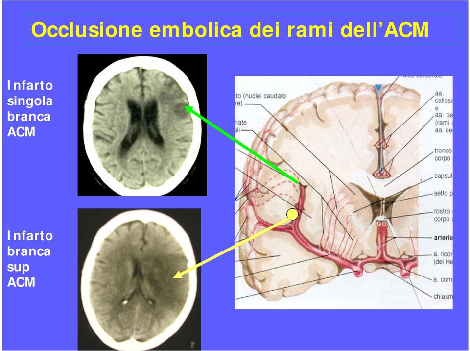 Infarto singola