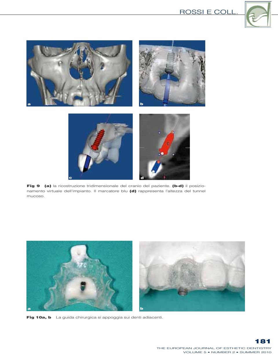 paziente. (b-d) il posizionamento virtuale dell impianto.