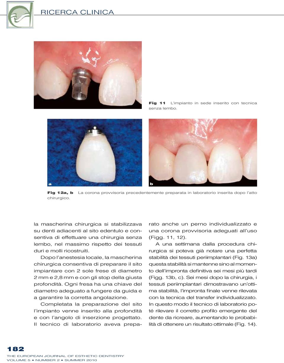 Dopo l anestesia locale, la mascherina chirurgica consentiva di preparare il sito impiantare con 2 sole frese di diametro 2 mm e 2,8 mm e con gli stop della giusta profondità.