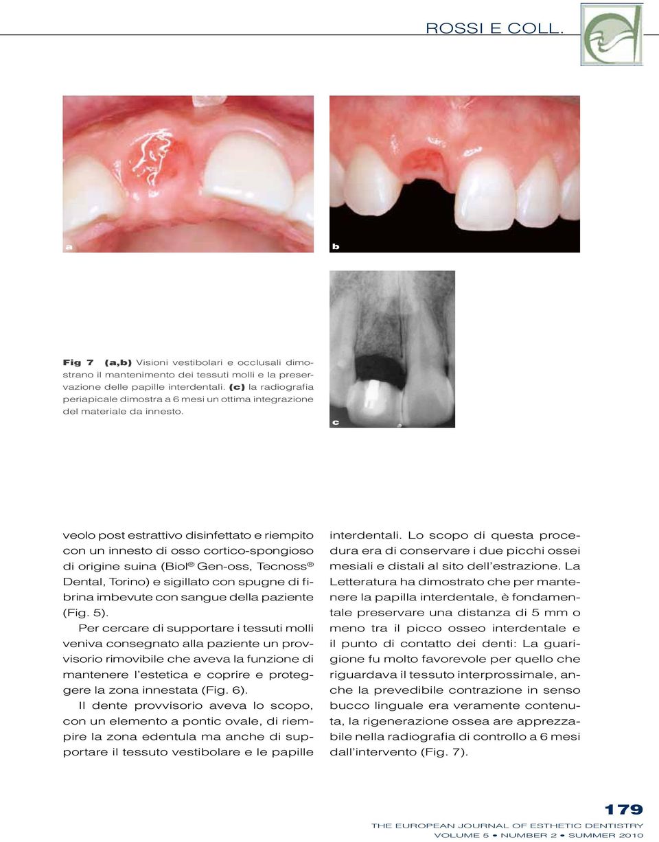 c veolo post estrattivo disinfettato e riempito con un innesto di osso cortico-spongioso di origine suina (Biol Gen-oss, Tecnoss Dental, Torino) e sigillato con spugne di fibrina imbevute con sangue