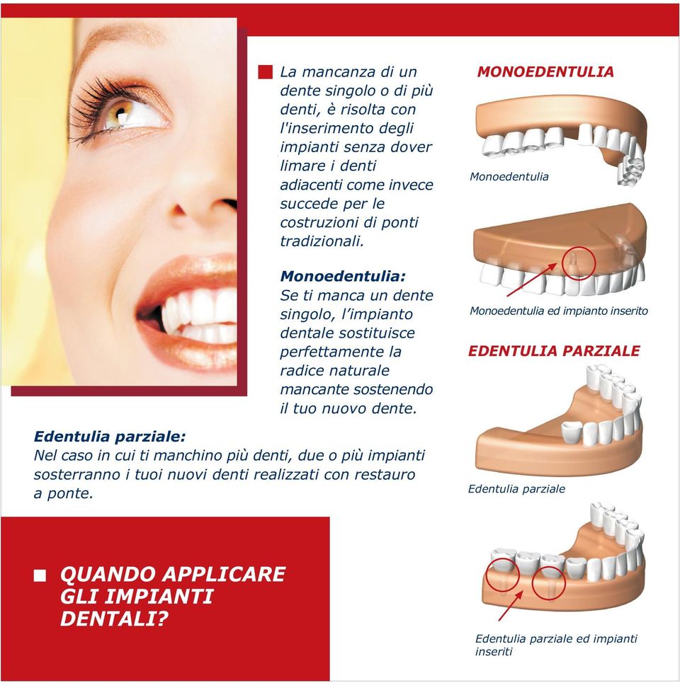 Monoedentulia: Se ti manca un dente singolo, l impianto dentale sostituisce perfettamente la radice naturale mancante sostenendo il tuo nuovo dente.