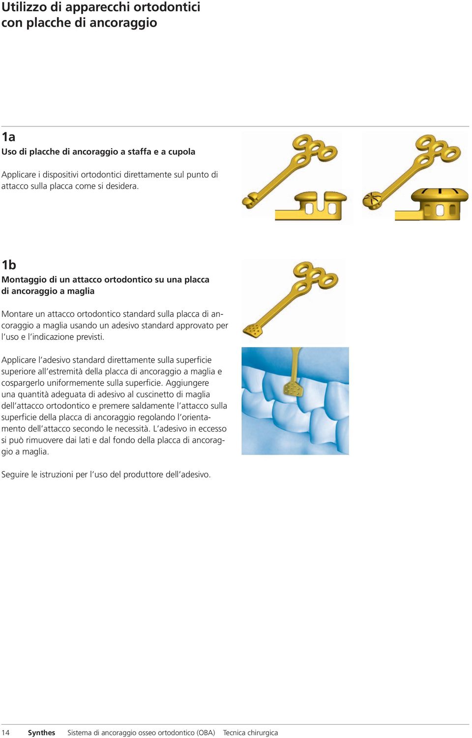 1b Montaggio di un attacco ortodontico su una placca di ancoraggio a maglia Montare un attacco ortodontico standard sulla placca di ancoraggio a maglia usando un adesivo standard approvato per l uso