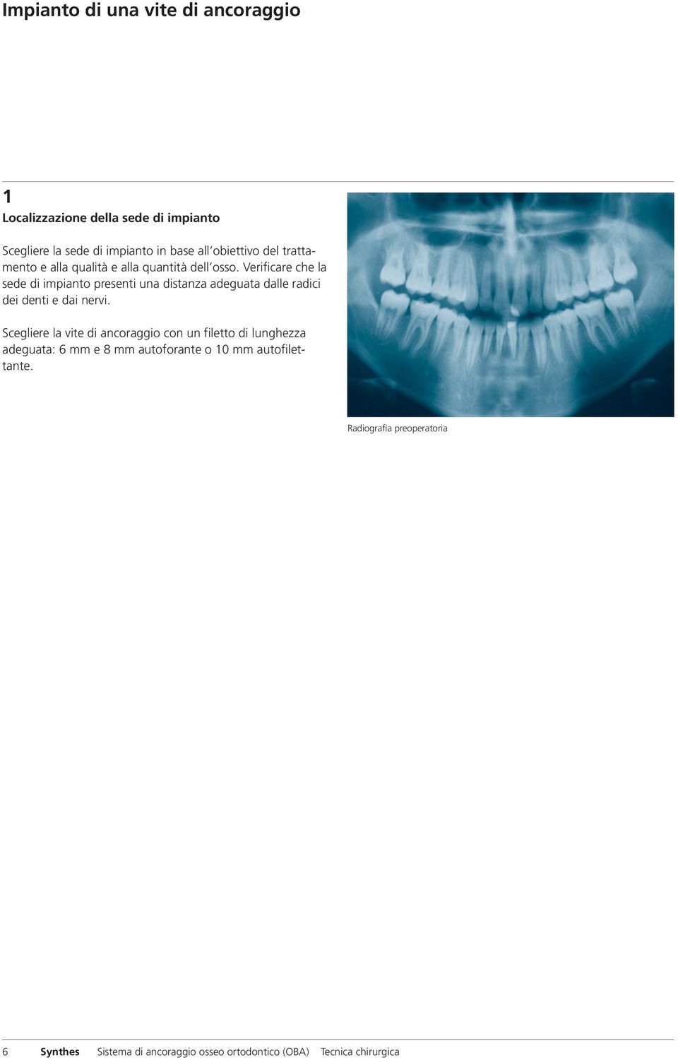 Verificare che la sede di impianto presenti una distanza adeguata dalle radici dei denti e dai nervi.