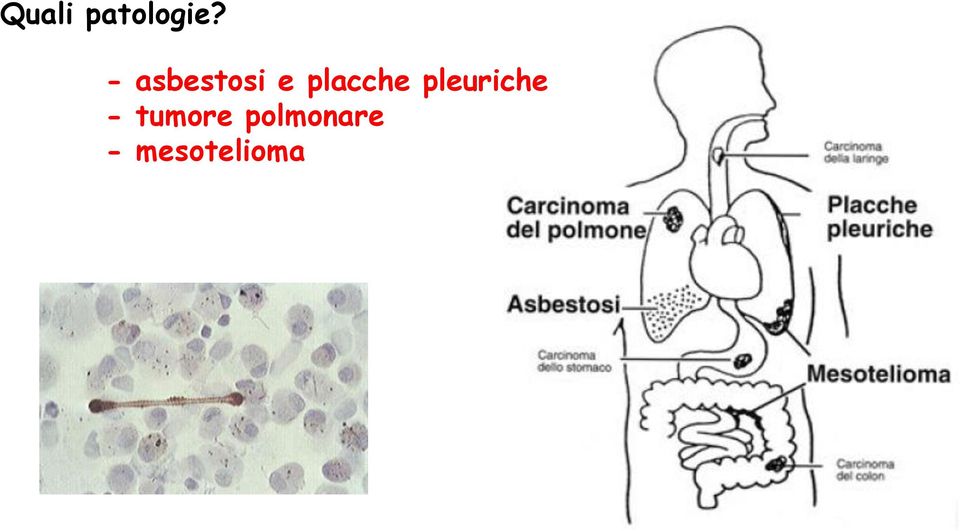 placche pleuriche -