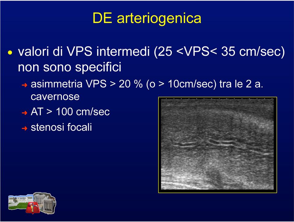 asimmetria VPS > 20 % (o > 10cm/sec) tra