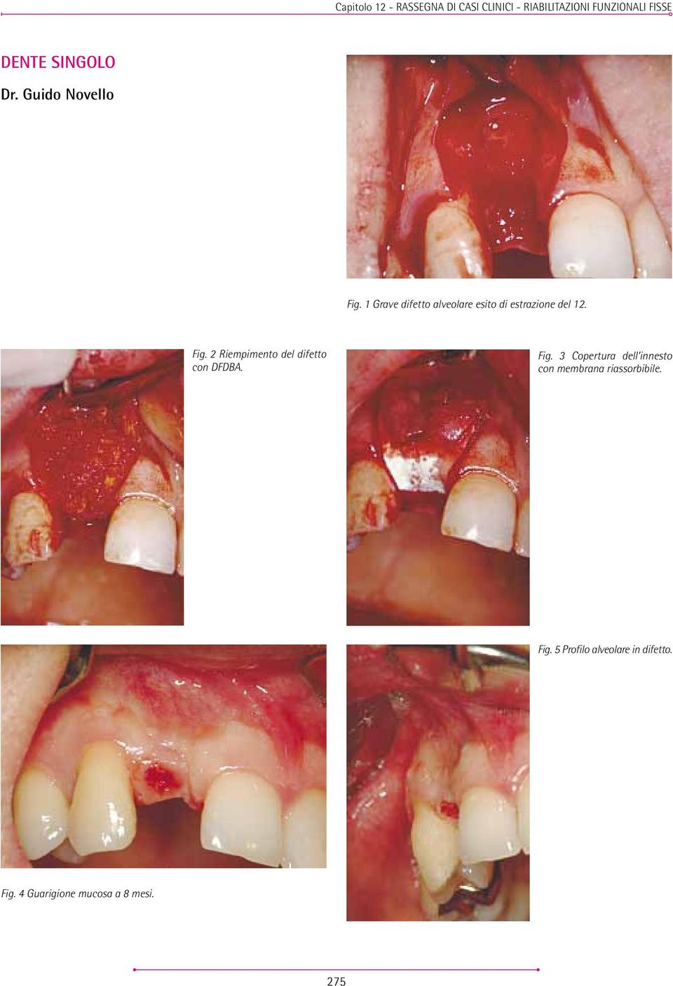 Fig. 2 Riempimento del difetto con DFDBA. Fig.