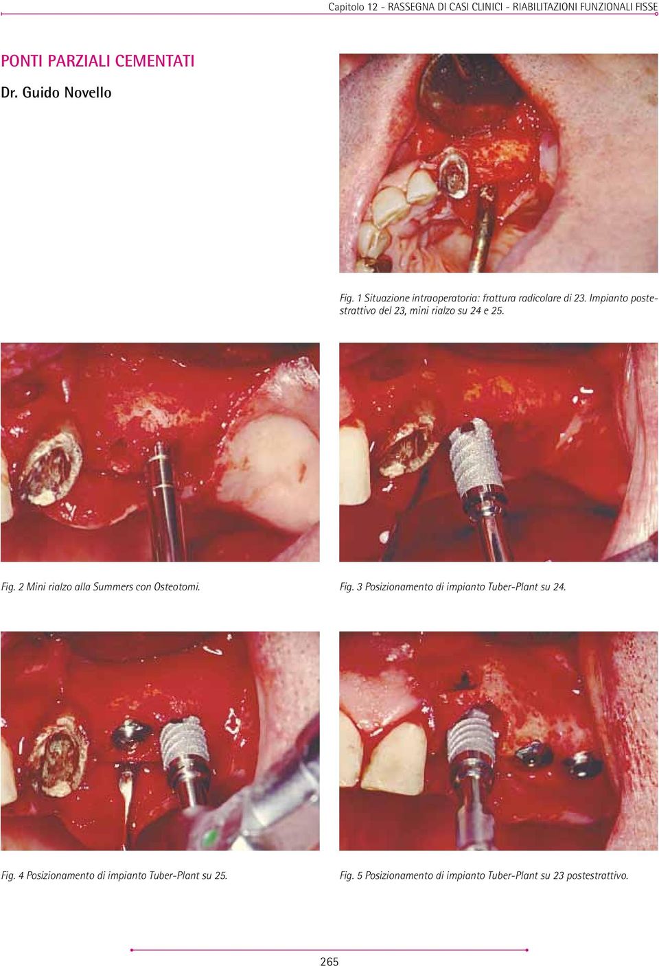 Impianto postestrattivo del 23, mini rialzo su 24 e 25. Fig. 2 Mini rialzo alla Summers con Osteotomi. Fig. 3 Posizionamento di impianto Tuber-Plant su 24.