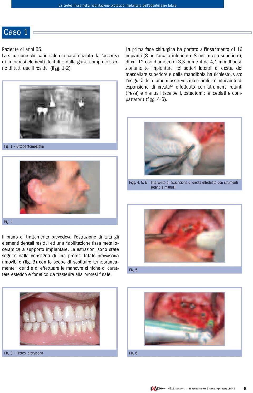Il posizionamento implantare nei settori laterali di destra del mascellare superiore e della mandibola ha richiesto, visto l'esiguità dei diametri ossei vestibolo-orali, un intervento di espansione