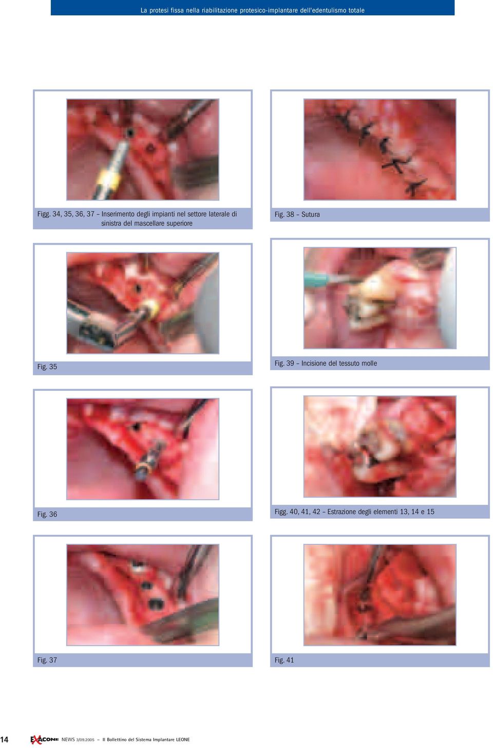 39 Incisione del tessuto molle Fig. 36 Figg.