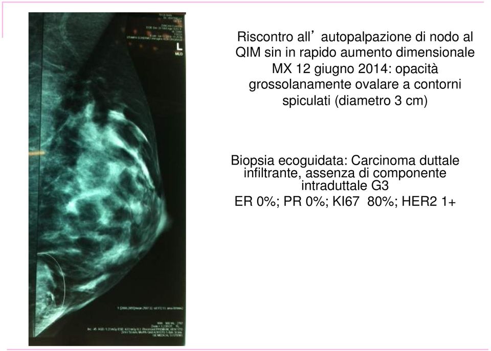 contorni spiculati (diametro 3 cm) Biopsia ecoguidata: Carcinoma