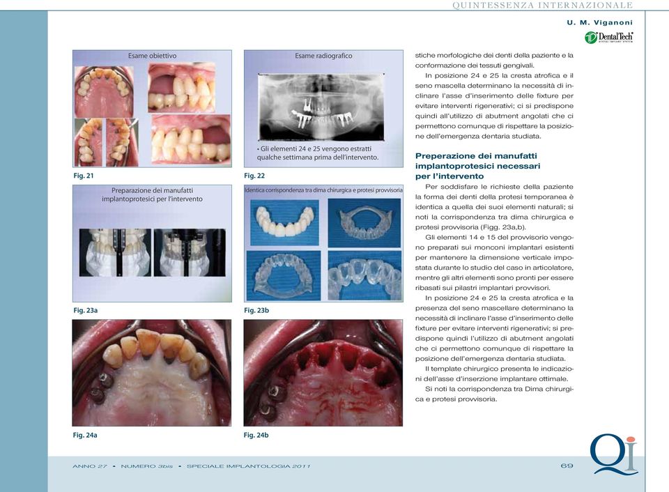 Identica corrispondenza tra dima chirurgica e protesi provvisoria Fig. 23b stiche morfologiche dei denti della paziente e la conformazione dei tessuti gengivali.