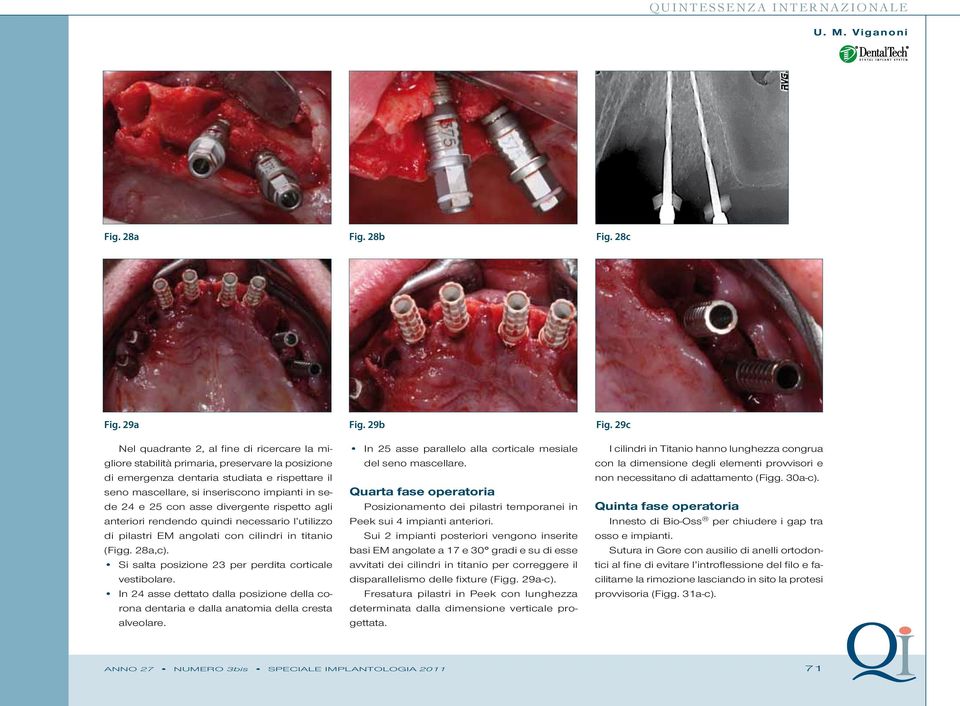 25 con asse divergente rispetto agli anteriori rendendo quindi necessario l utilizzo di pilastri EM angolati con cilindri in titanio (Figg. 28a,c).