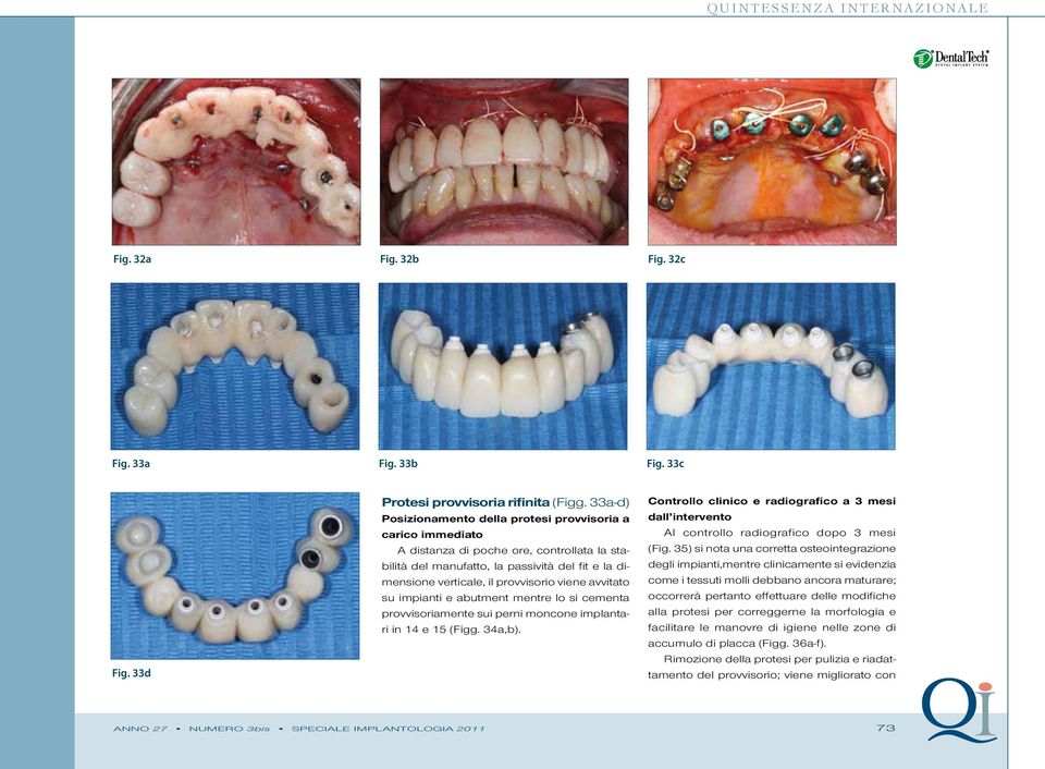 viene avvitato su impianti e abutment mentre lo si cementa provvisoriamente sui perni moncone implantari in 14 e 15 (Figg. 34a,b).