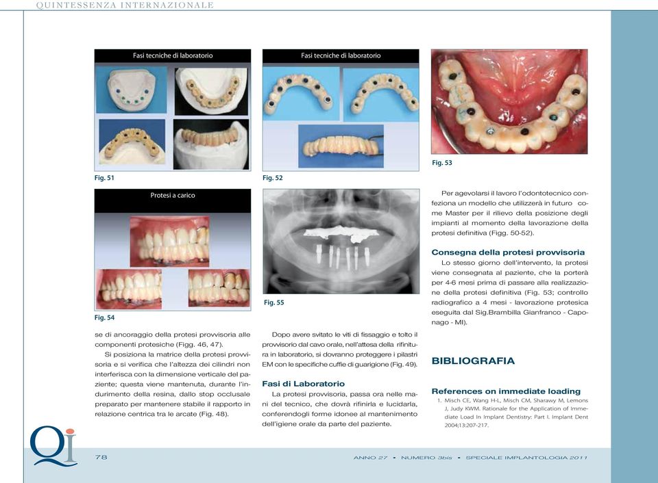 della protesi definitiva (Figg. 50-52). Fig. 54 se di ancoraggio della protesi provvisoria alle componenti protesiche (Figg. 46, 47).