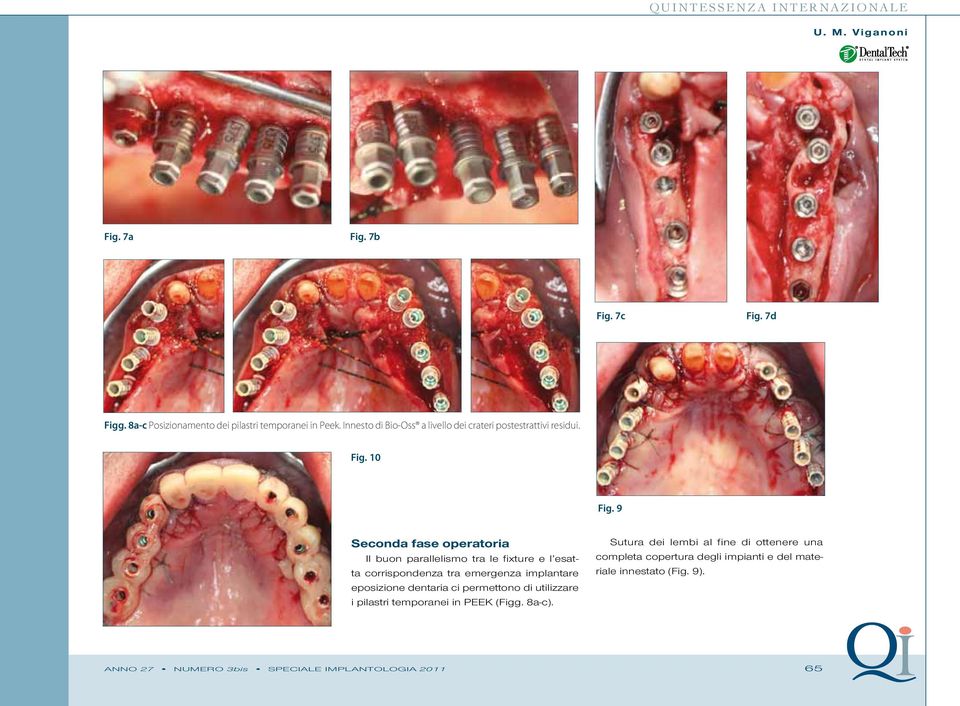 9 Seconda fase operatoria Il buon parallelismo tra le fixture e l esatta corrispondenza tra emergenza implantare eposizione dentaria ci
