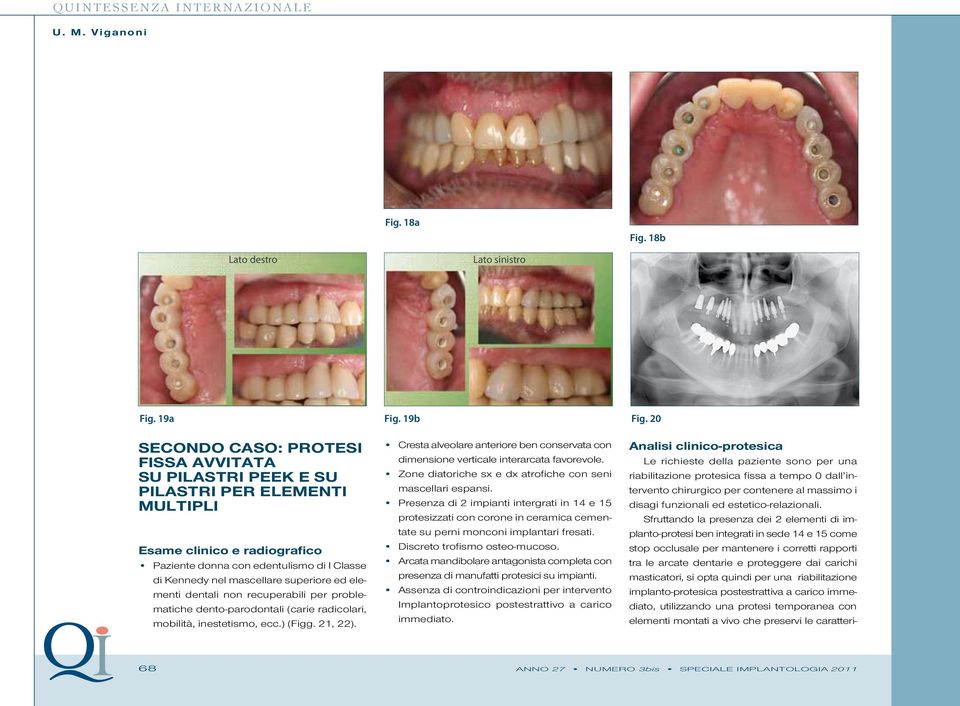 superiore ed elementi dentali non recuperabili per problematiche dento-parodontali (carie radicolari, mobilità, inestetismo, ecc.) (Figg. 21, 22).