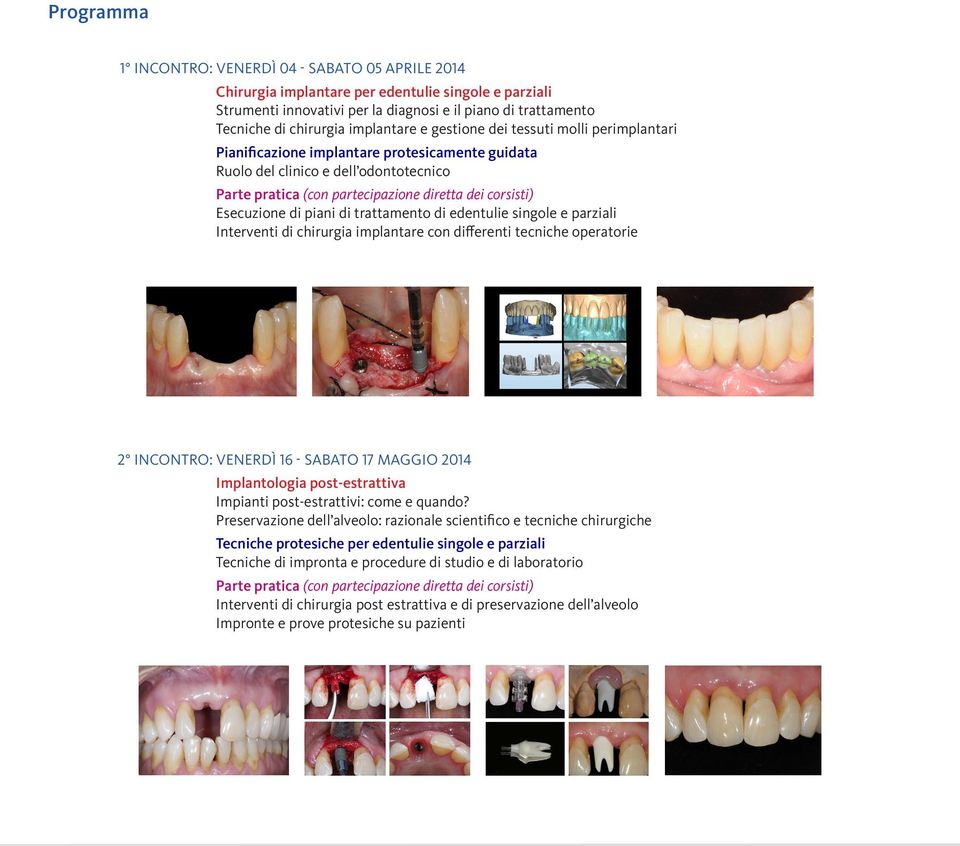 Esecuzione di piani di trattamento di edentulie singole e parziali Interventi di chirurgia implantare con differenti tecniche operatorie 2 INCONTRO: VENERDÌ 16 - SABATO 17 MAGGIO 2014 Implantologia