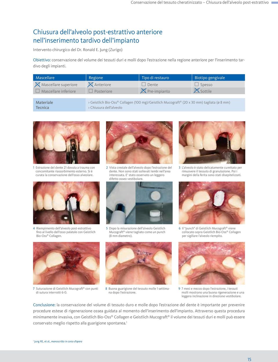 Mascellare Regione Tipo di restauro Biotipo gengivale Mascellare superiore Anteriore Dente Spesso Mascellare inferiore Posteriore Pre-impianto Sottile Materiale Tecnica > Geistlich Bio-Oss Collagen