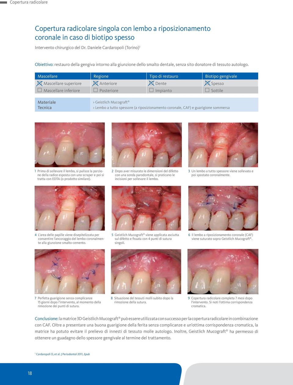 Mascellare Regione Tipo di restauro Biotipo gengivale Mascellare superiore Anteriore Dente Spesso Mascellare inferiore Posteriore Impianto Sottile Materiale Tecnica > Geistlich Mucograft > Lembo a