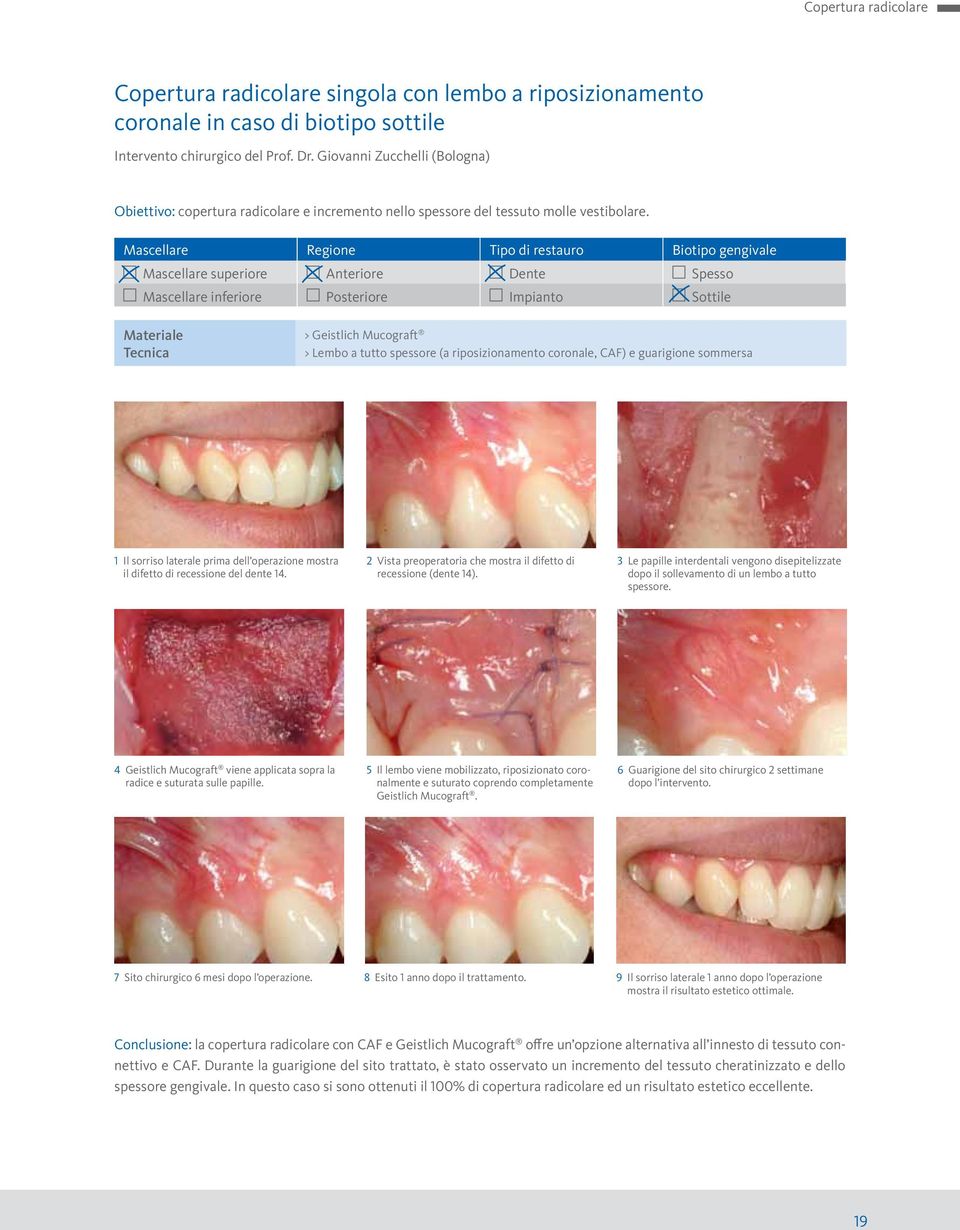 Mascellare Regione Tipo di restauro Biotipo gengivale Mascellare superiore Anteriore Dente Spesso Mascellare inferiore Posteriore Impianto Sottile Materiale Tecnica > Geistlich Mucograft > Lembo a