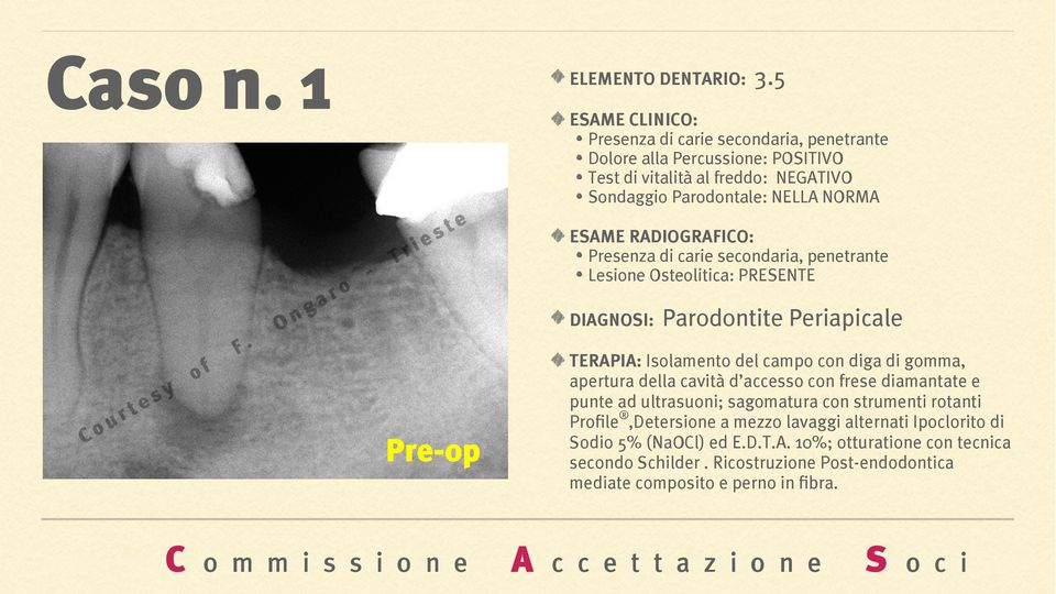 secondaria, penetrante Lesione Osteolitica: PRESENTE DIAGNOSI: Parodontite Periapicale TERAPIA: Isolamento del campo con diga di gomma, apertura della cavità d accesso
