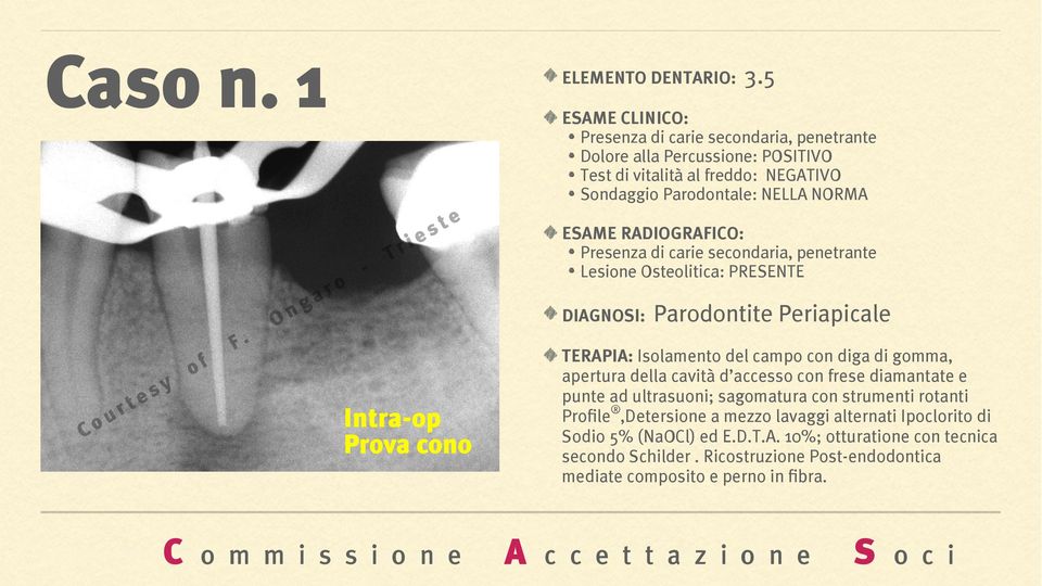 secondaria, penetrante Lesione Osteolitica: PRESENTE DIAGNOSI: Parodontite Periapicale TERAPIA: Isolamento del campo con diga di gomma, apertura della cavità d accesso con