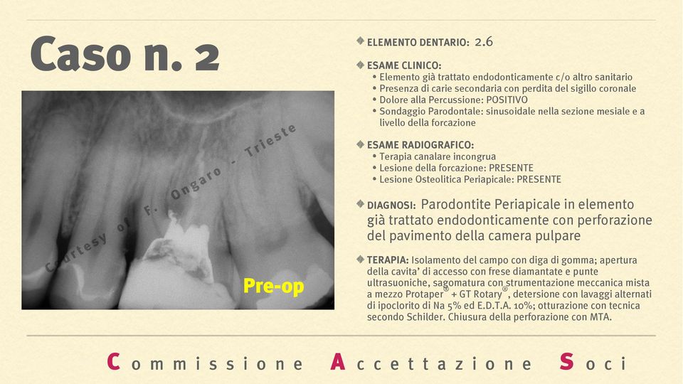 sezione mesiale e a livello della forcazione Terapia canalare incongrua Lesione della forcazione: PRESENTE Lesione Osteolitica Periapicale: PRESENTE DIAGNOSI: Parodontite Periapicale in elemento già