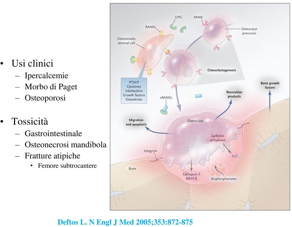 Osteonecrosi mandibola Fratture atipiche