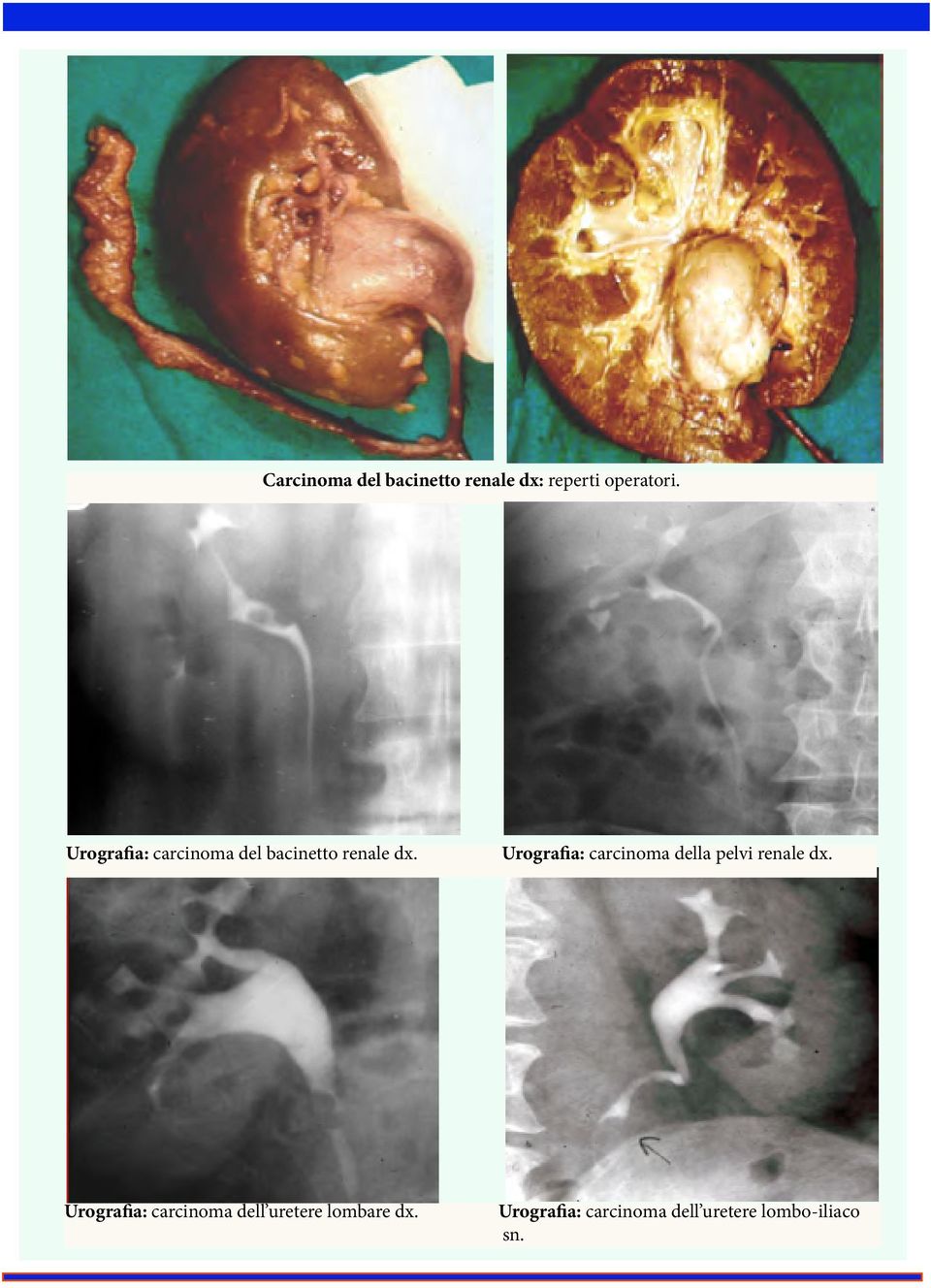 Urografia: carcinoma della pelvi renale dx.