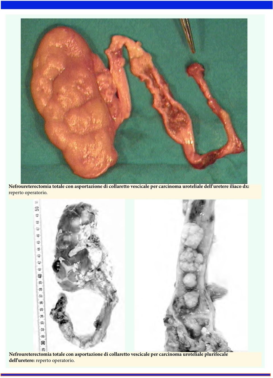 per carcinoma uroteliale plurifocale dell uretere: reperto