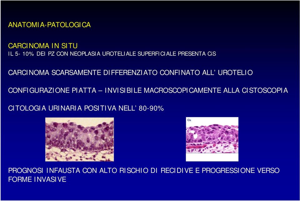 CONFIGURAZIONE PIATTA INVISIBILE MACROSCOPICAMENTE ALLA CISTOSCOPIA CITOLOGIA URINARIA