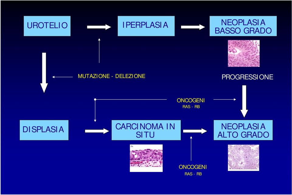 ONCOGENI RAS - RB DISPLASIA CARCINOMA IN