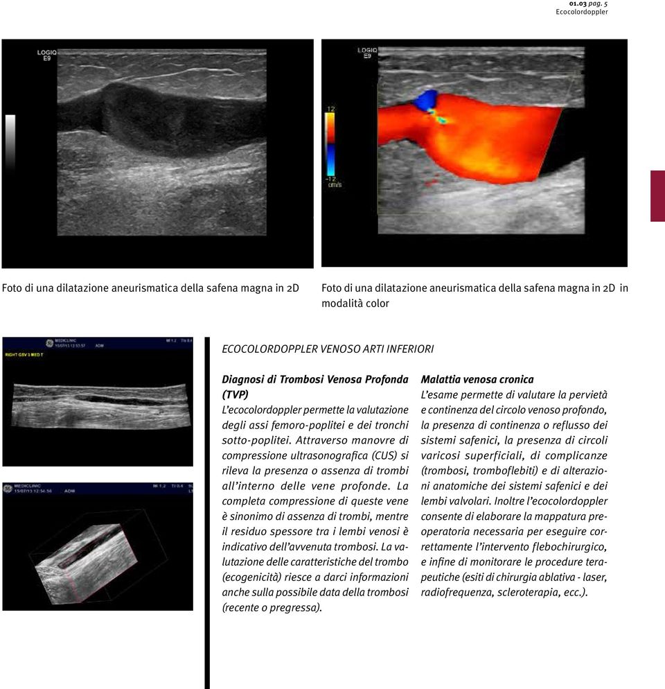 Trombosi Venosa Profonda (TVP) L ecocolordoppler permette la valutazione degli assi femoro-poplitei e dei tronchi sotto-poplitei.