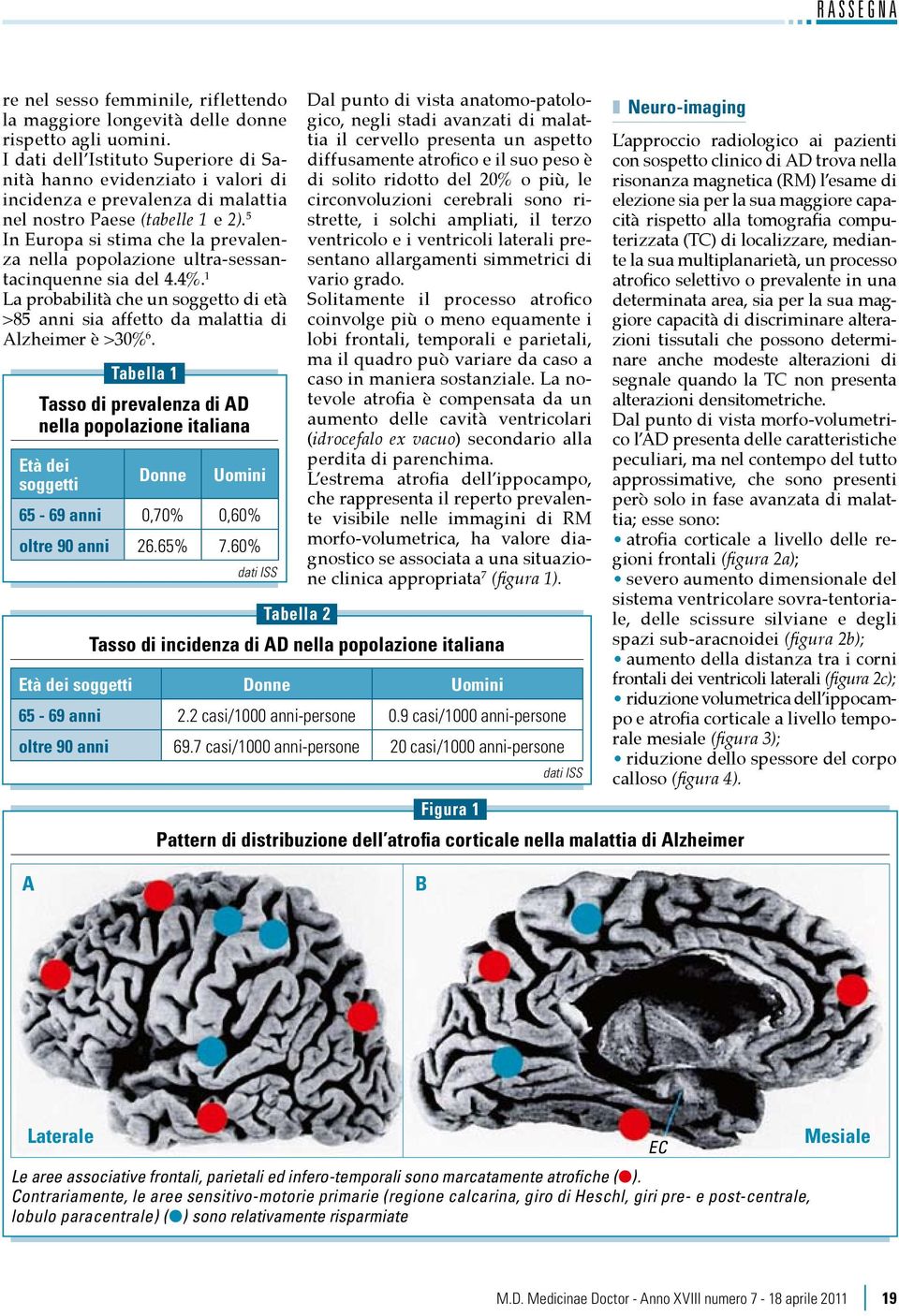 5 In Europa si stima che la prevalenza nella popolazione ultra-sessantacinquenne sia del 4.4%. 1 La probabilità che un soggetto di età >85 anni sia affetto da malattia di Alzheimer è >30% 6.